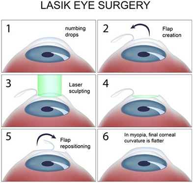 Laser Eye Surgery